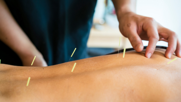 Acupuncture needles being placed in a patient's back.